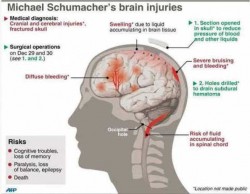 SCHUMACHER-BRAIN-INJURIES 2