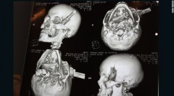 MAN DRIVES HIMSELF TO HOSPITAL WITH BUTCHER KNIFE IN HEAD (2)